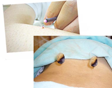 鍼灸 はりきゅう